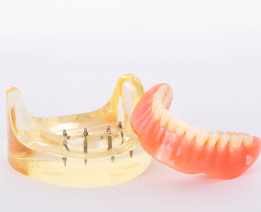 Implant-Retained Dentures