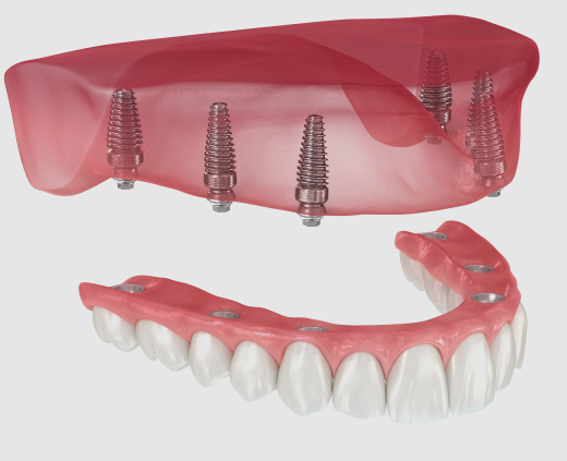 Snap-in Dentures
