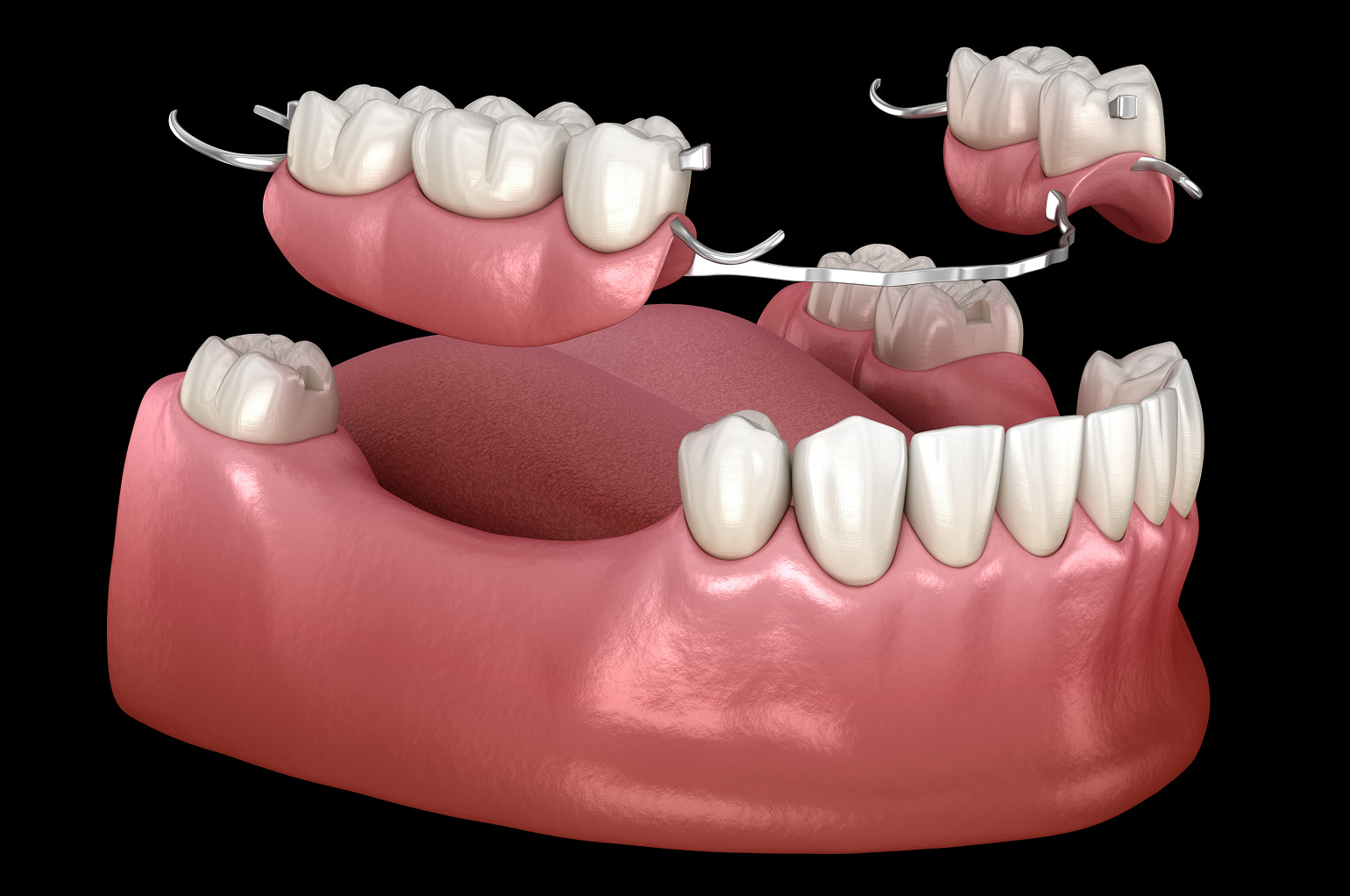 Removable dentures for full or partial tooth replacement