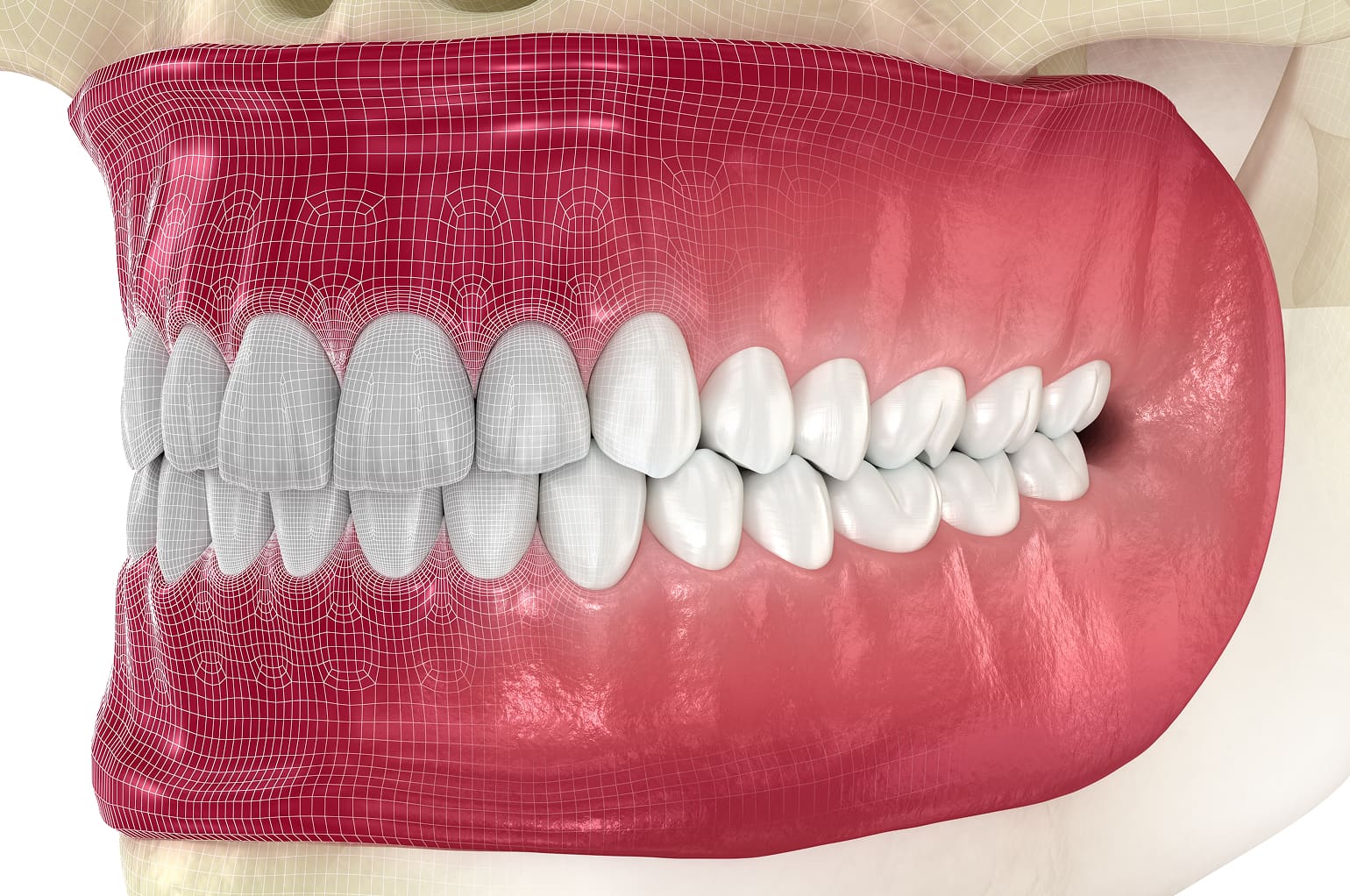 Advantages of modern digital dentures for missing teeth