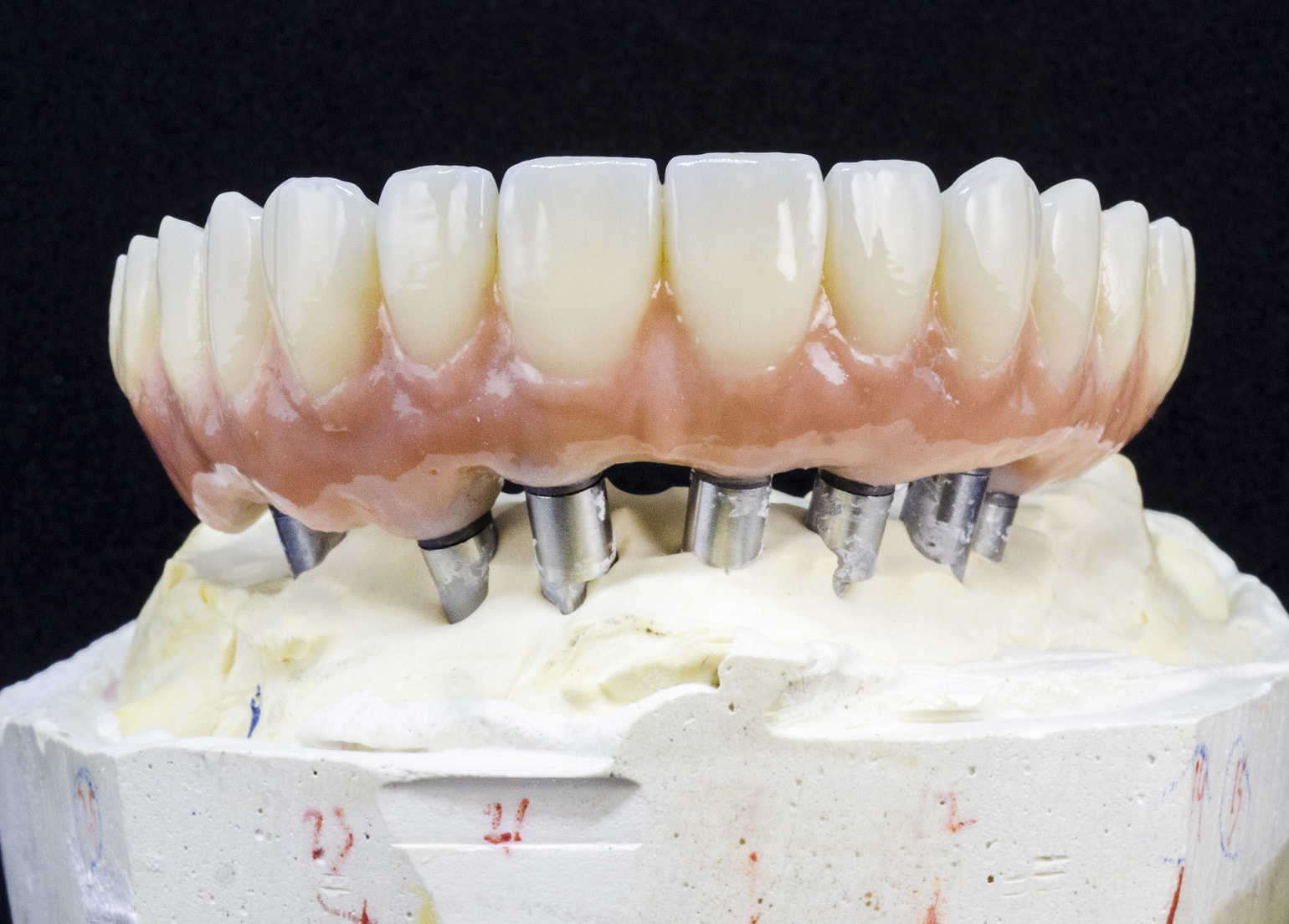 Stable and natural-looking full mouth dental implants