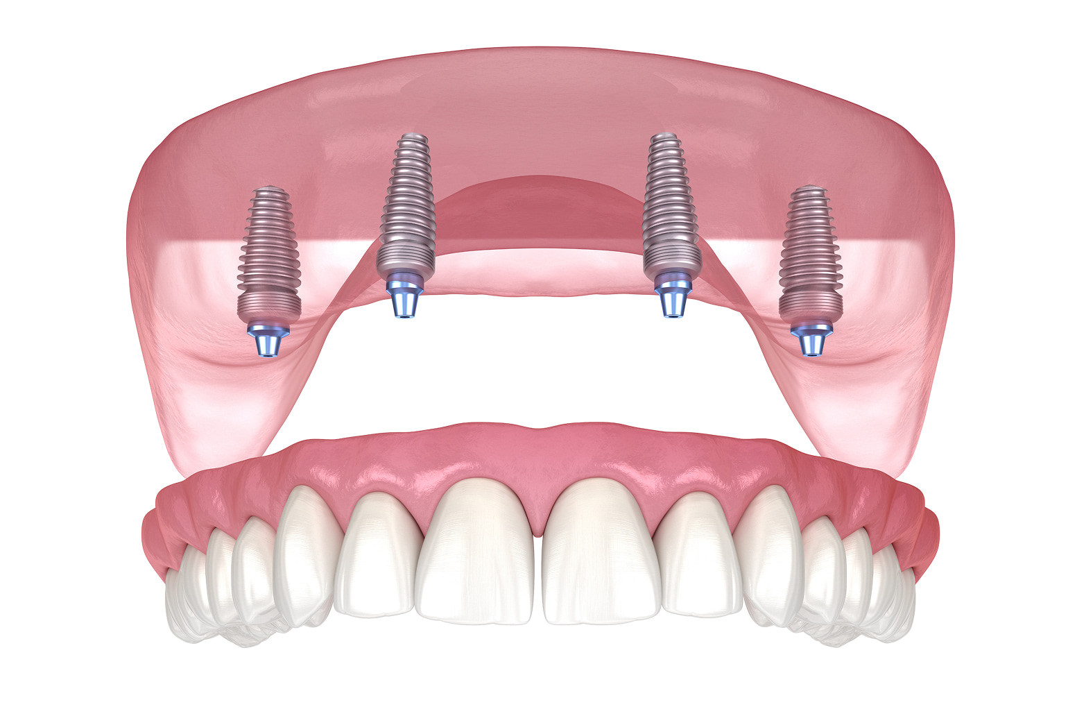 Stable and natural-looking implant-supported dentures