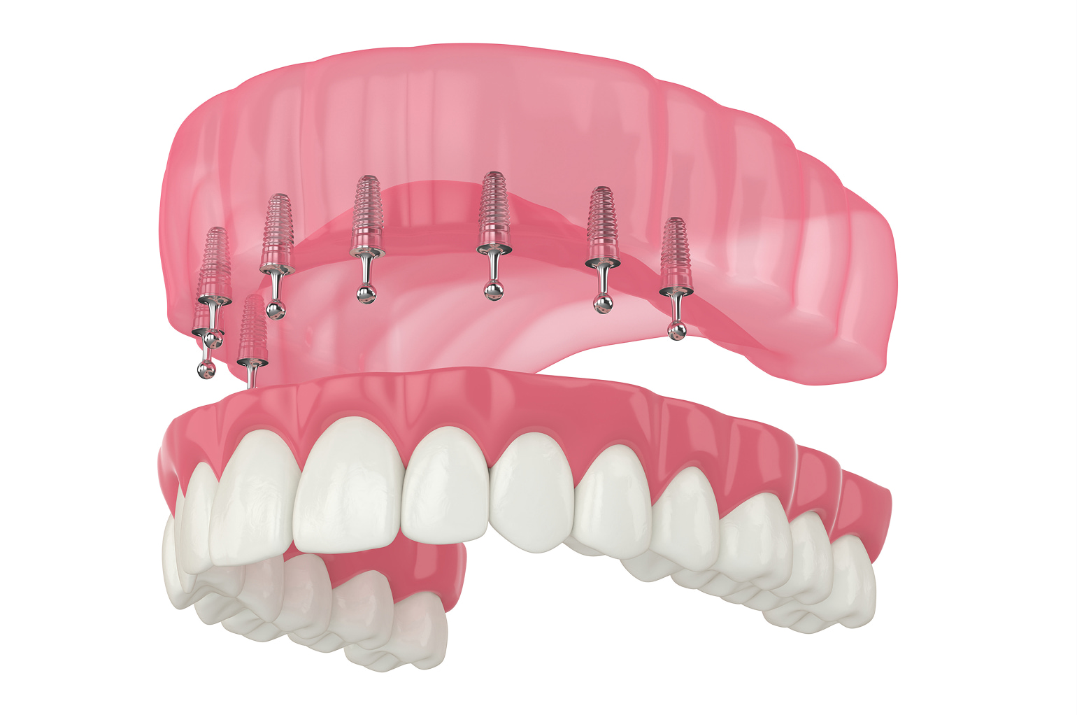 Removable implant dentures for comfort and stability